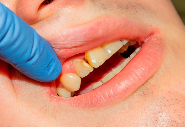 detectar caries a tiempo