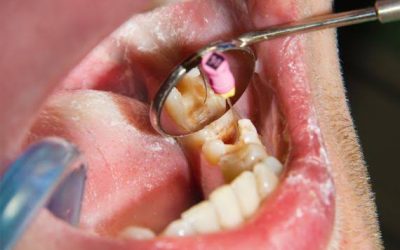 Cuándo es necesaria una endodoncia