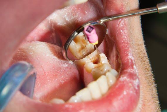 endodoncia